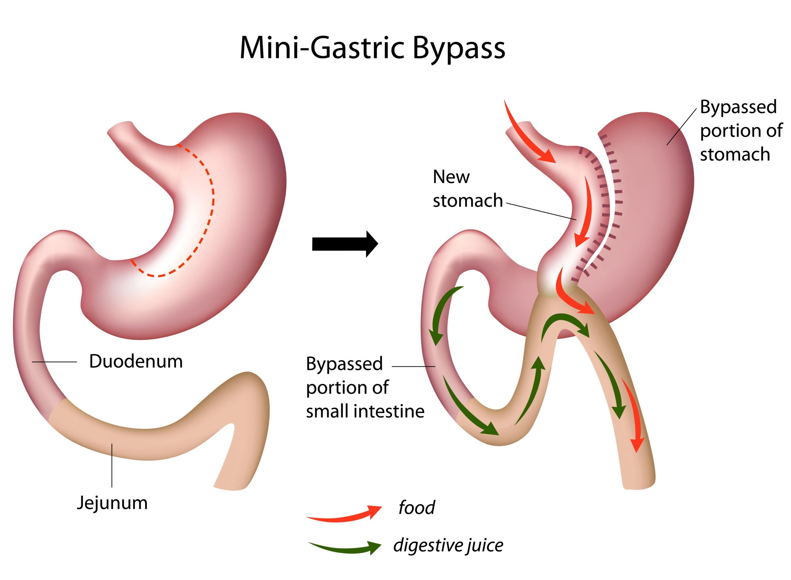 Sleeve Gastrectomy