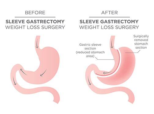 Sleeve Gastrectomy