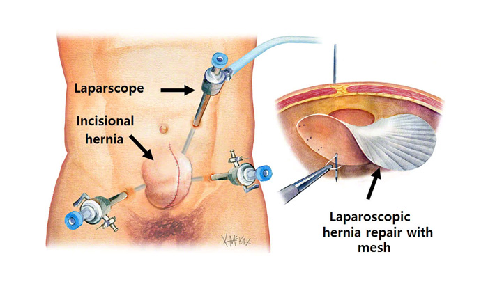 Laproscopic Hernia Surgery